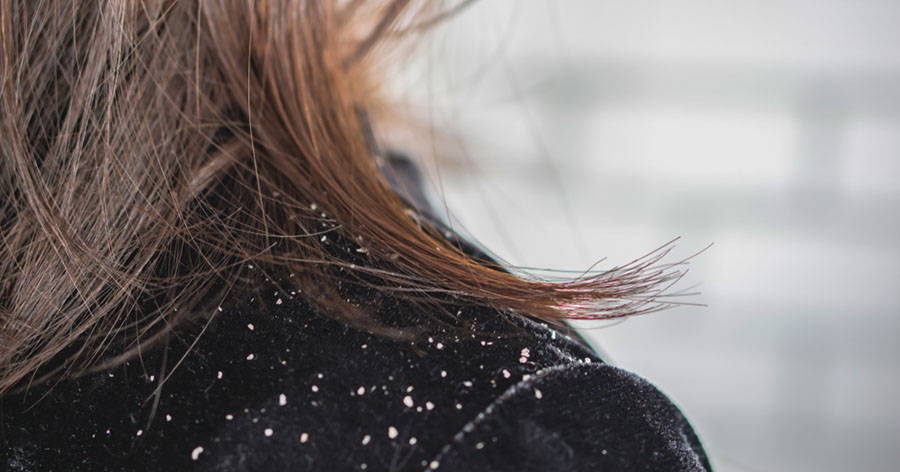 Dandruff vs. Dry Scalp: Understanding the Differences