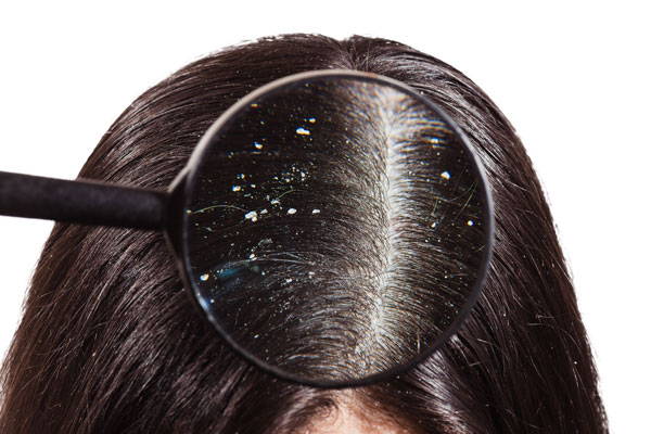 How Does Dandruff Occur & How Can I Manage It?