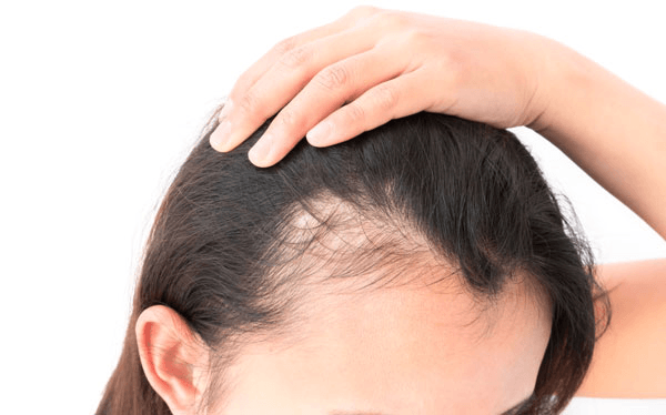 Learn About Stress-Induced Hair Loss