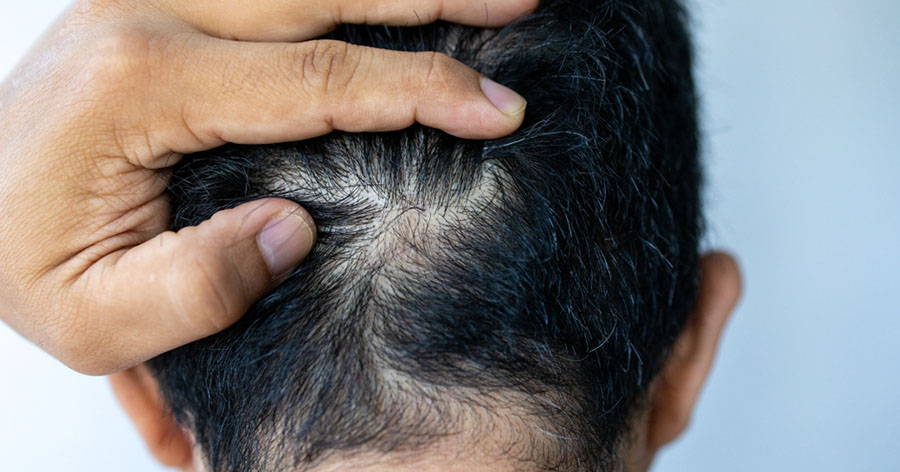 Your Guide to Hair Restoration & Common Hair Regrowth Terms