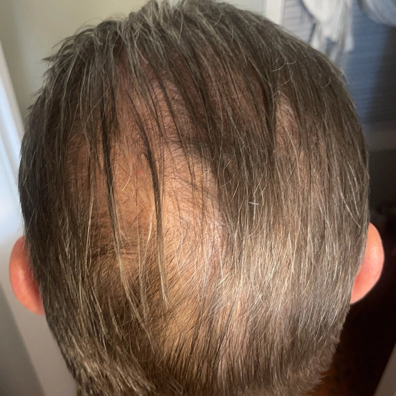 The image shows the back of a persons head with thinning hair on the crown, revealing some scalp. The hair is predominantly brown with strands of gray.