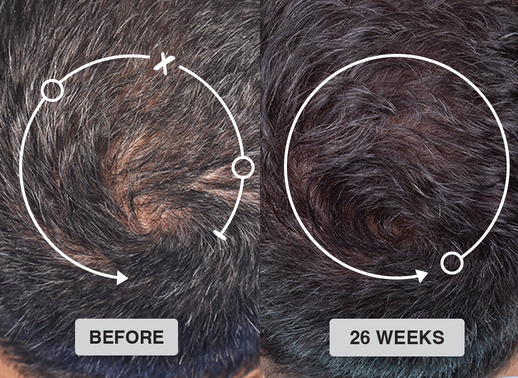 Side-by-side comparison of the crown of a scalp showing thinning hair labeled Before and visibly thicker hair labeled 26 Weeks, with white arrows and circles highlighting the same area in both images.