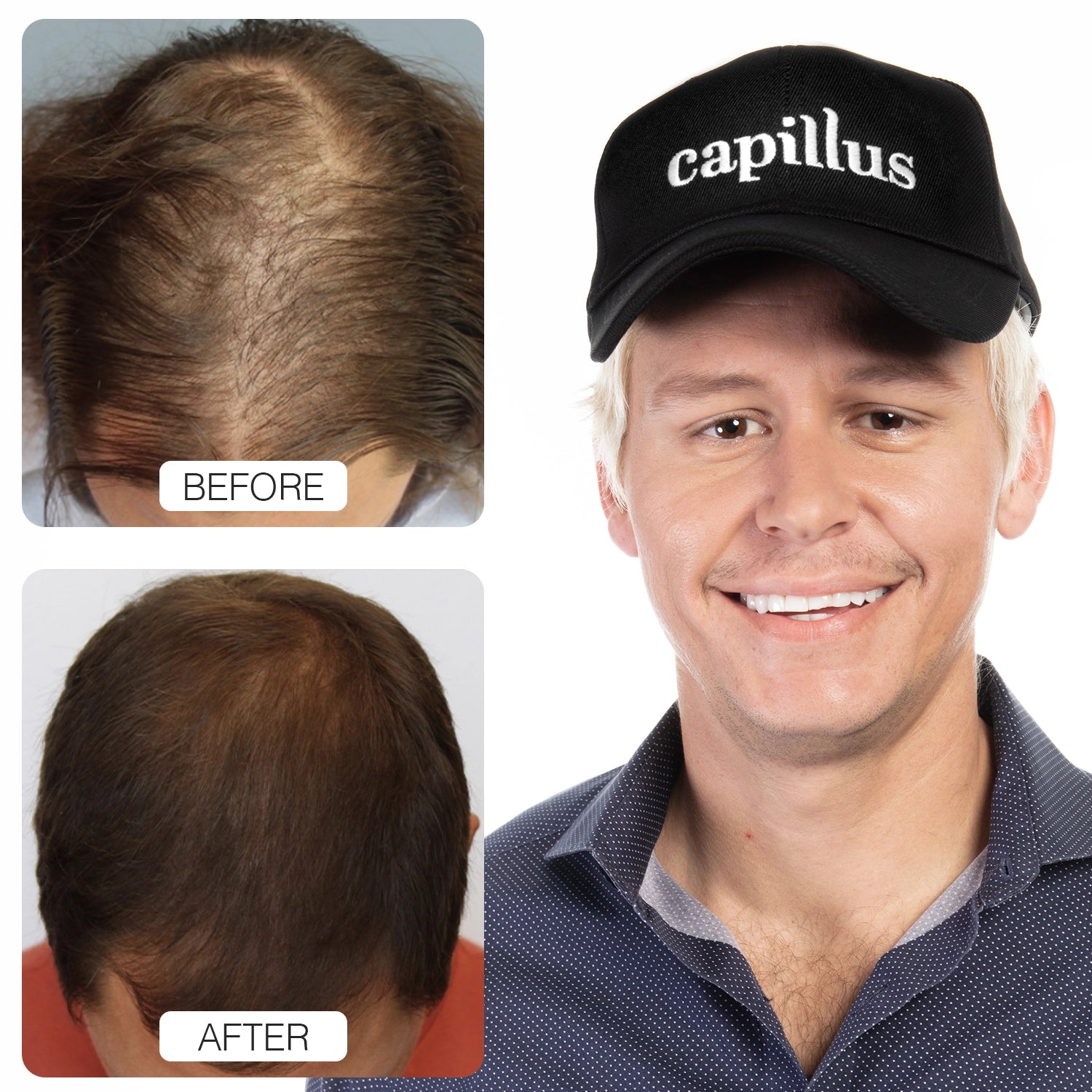 A before-and-after comparison of hair growth on a scalp is shown, next to a smiling man wearing a black cap that says capillus. The before image shows thinning hair; the after image shows fuller hair.