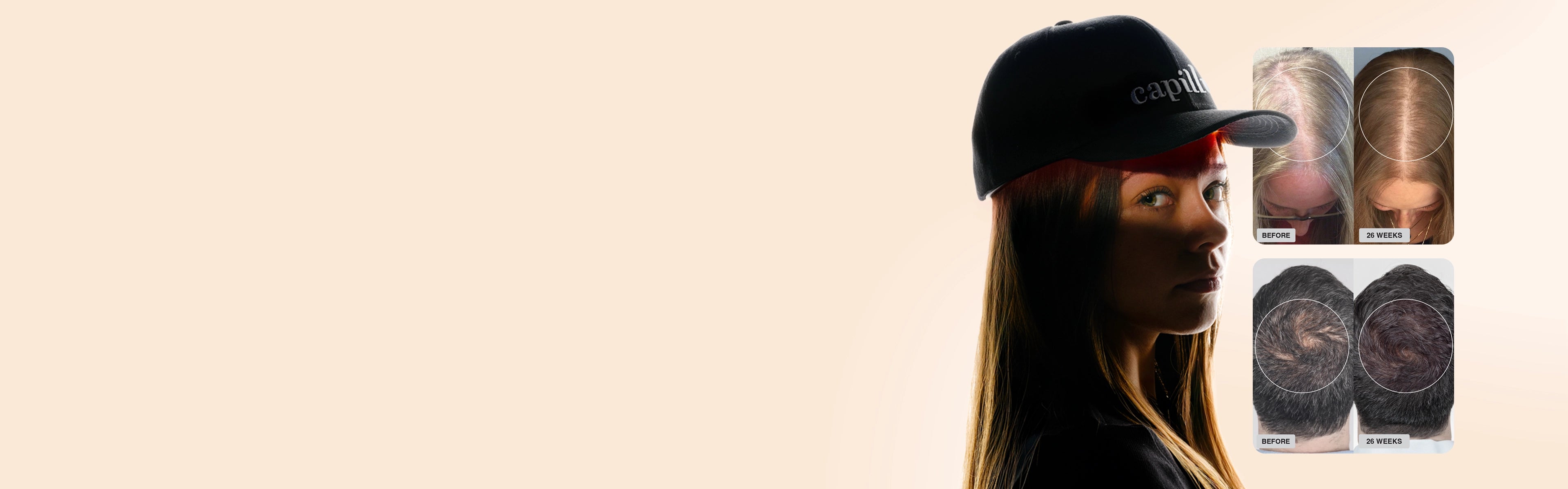 A person wearing a black cap faces the camera in profile, with a serious expression. To the right, before-and-after images show improvements in hair density on the tops of two people’s heads.