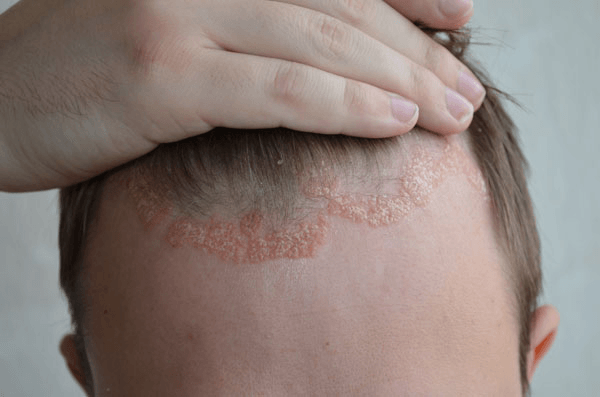 Psoriasis on the Scalp