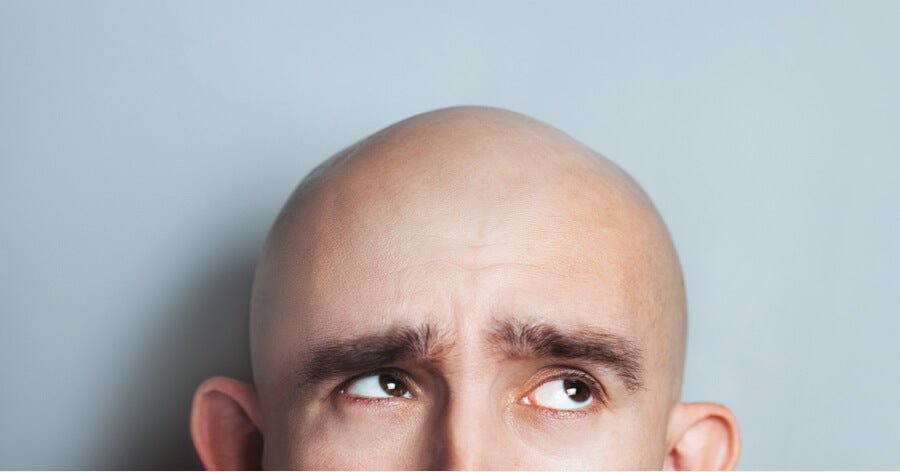 Is the Capillus Laser Cap Appropriate for Extreme Hair Loss or Baldness?