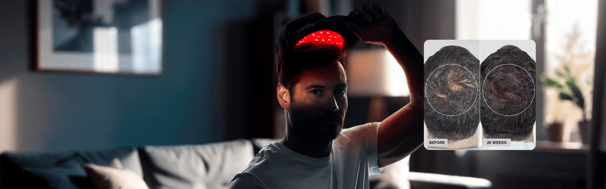 Un homme est assis à l'intérieur, tenant au-dessus de sa tête un casque muni de lumières rouges clignotantes ; un encadré présente des photos avant/après montrant les résultats de la repousse des cheveux sur une période de 26 semaines.