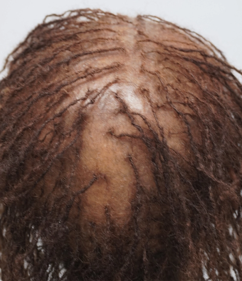 A close-up of a persons scalp with thinning hair and visible scalp, showing brown dreadlocks that are sparsely distributed and parted down the middle.