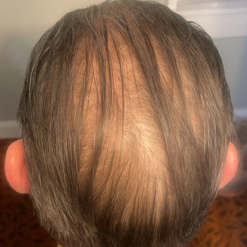 The image shows the back of a persons head with thinning hair and a prominent bald spot at the crown. The surrounding hair is dark and thin, and the persons ears are visible on both sides.