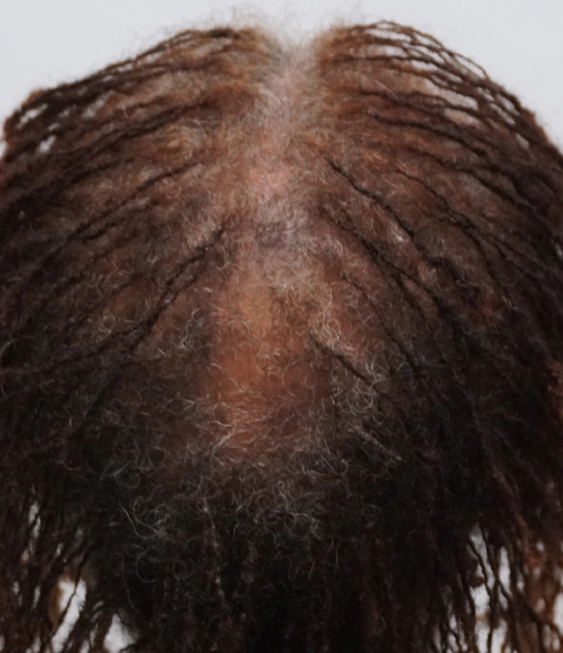 A close-up view of the top of a persons head with thinning hair and dreadlocks, showing significant scalp visibility and a mix of brown and gray hair.