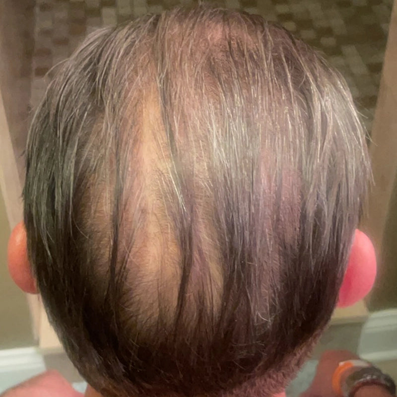 The image shows the back of a persons head with thinning hair and a visible bald spot on the crown. The hair appears fine and grayish-brown, and the background shows a tiled surface.