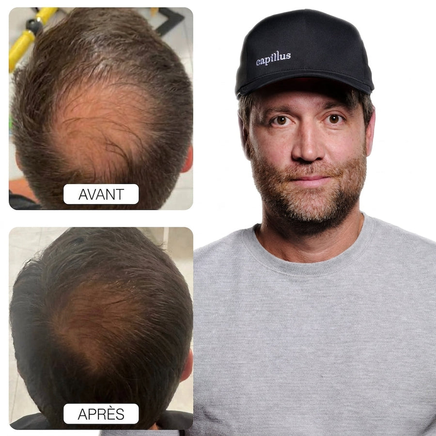 Before and after hair restoration result