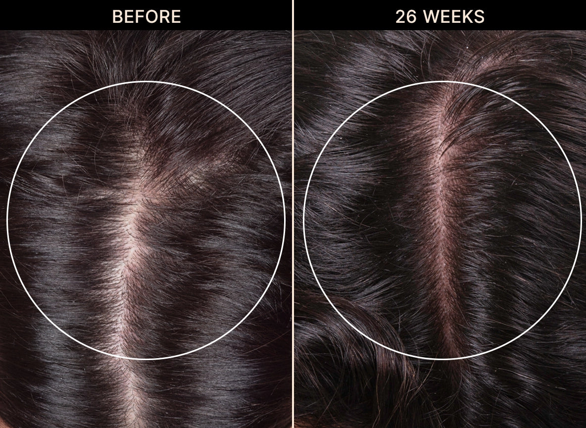 Side-by-side comparison of a person’s scalp before and after 26 weeks, showing reduced hair thinning and a fuller part in the 26 weeks image on the right.