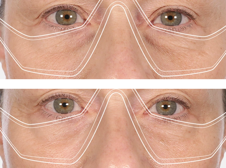 Close-up of a persons eyes and upper cheeks, shown in two images: the top image shows more visible wrinkles, while the bottom image shows smoother skin. White lines outline the eye and cheek areas.