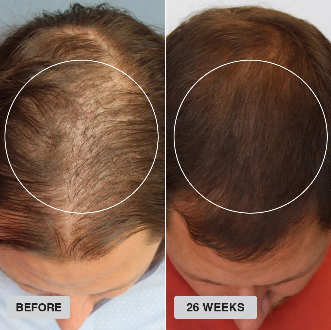 Split image showing the top of a mans head. The left side, labeled Before, shows thinning hair. The right side, labeled 26 Weeks, shows noticeably fuller, thicker hair within a circled area.