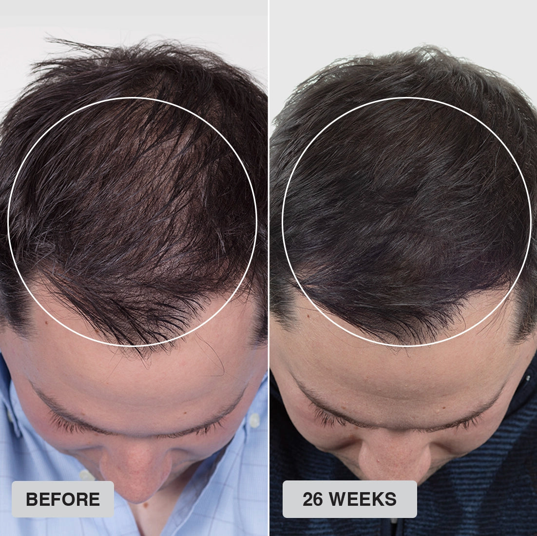 Side-by-side photos of a man’s scalp viewed from above; on the left, his hair is thin and sparse, labeled “BEFORE.” On the right, after “26 WEEKS,” his hair appears much thicker and fuller.