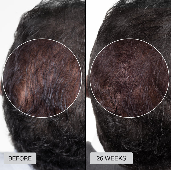 Lester - Before After