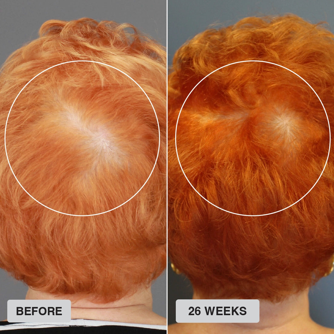 Side-by-side comparison of the back of a persons head with orange hair; left image shows thinning hair, right image (after 26 weeks) shows visibly thicker hair with less scalp showing.