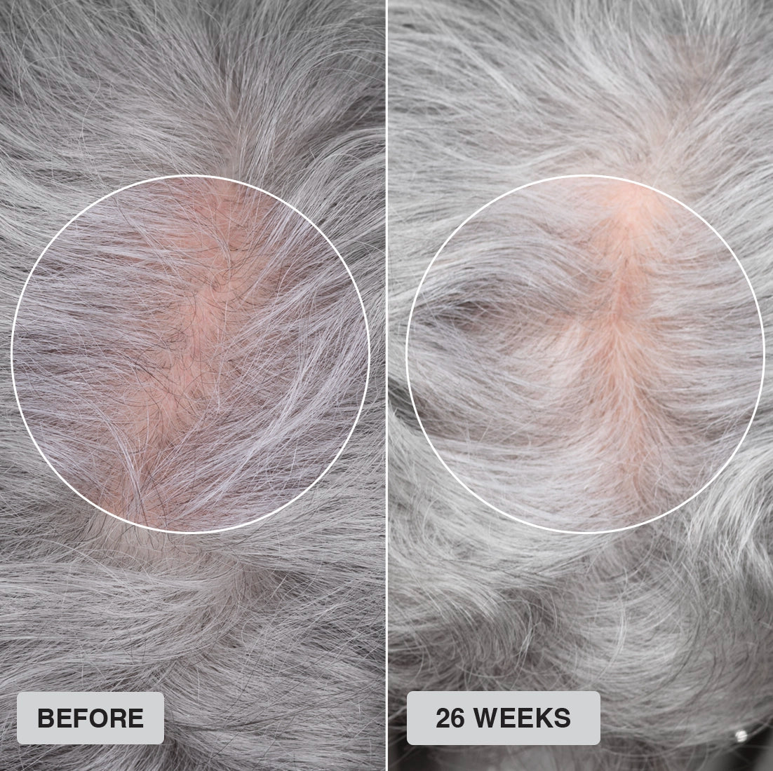 Side-by-side close-up of a scalp with gray hair. The left image, labeled Before, shows more visible scalp, while the right, labeled 26 Weeks, shows denser hair growth and less visible scalp in the circled areas.