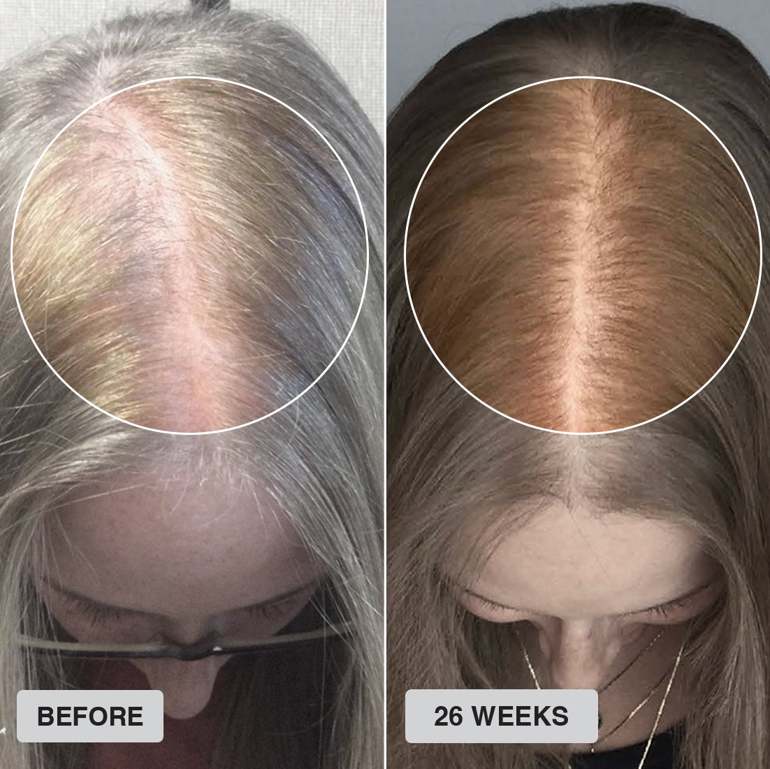 Side-by-side images of a persons scalp: the left shows thinning hair before treatment, while the right, labeled 26 weeks, shows noticeably fuller hair growth in the same area.