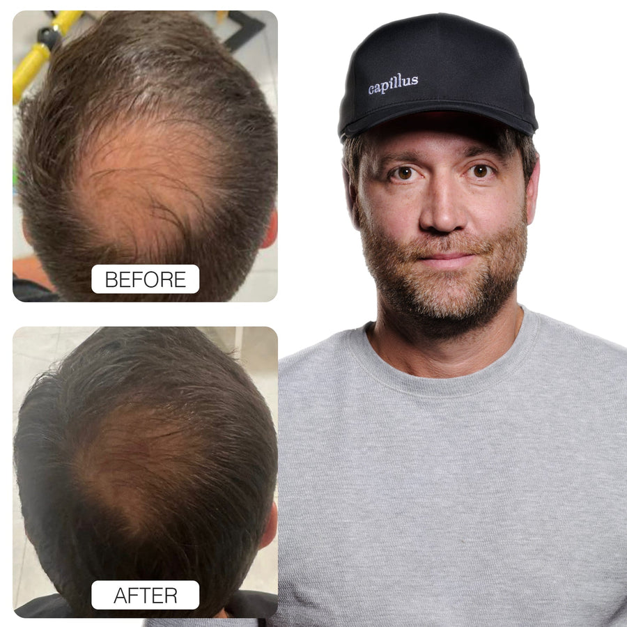 Before and after hair restoration result