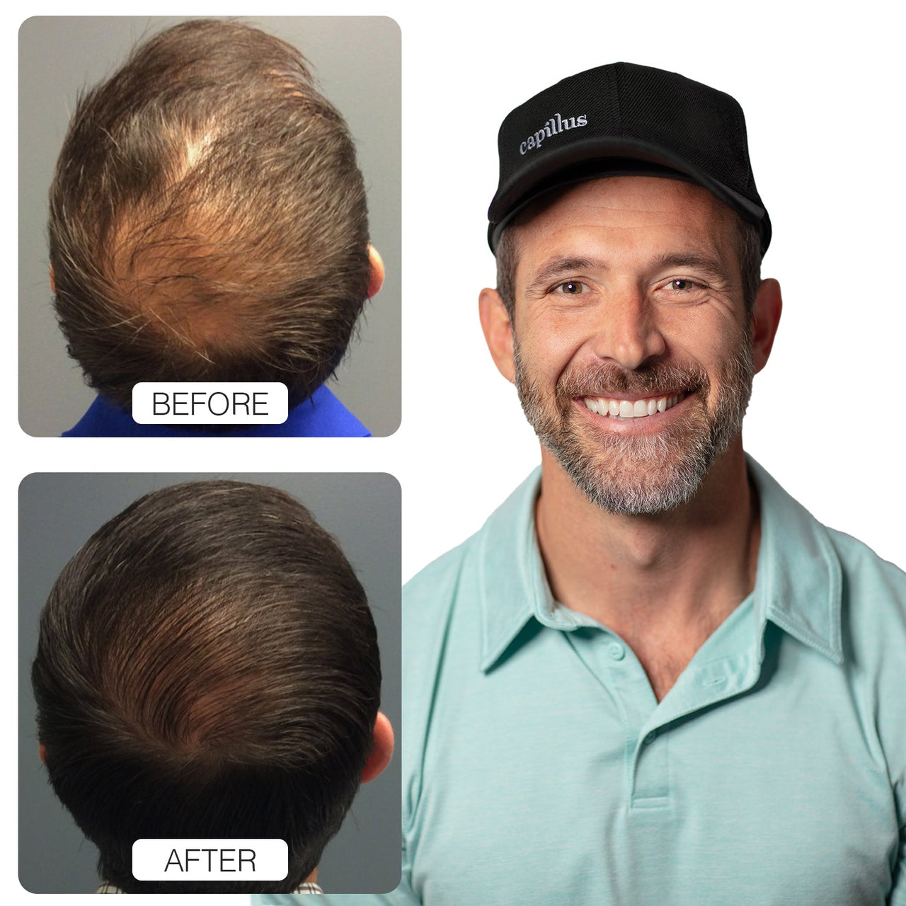 A before-and-after comparison shows the top of a mans head with thinning hair, then fuller hair. Next to these is a smiling man wearing a black cap and a light blue polo shirt.