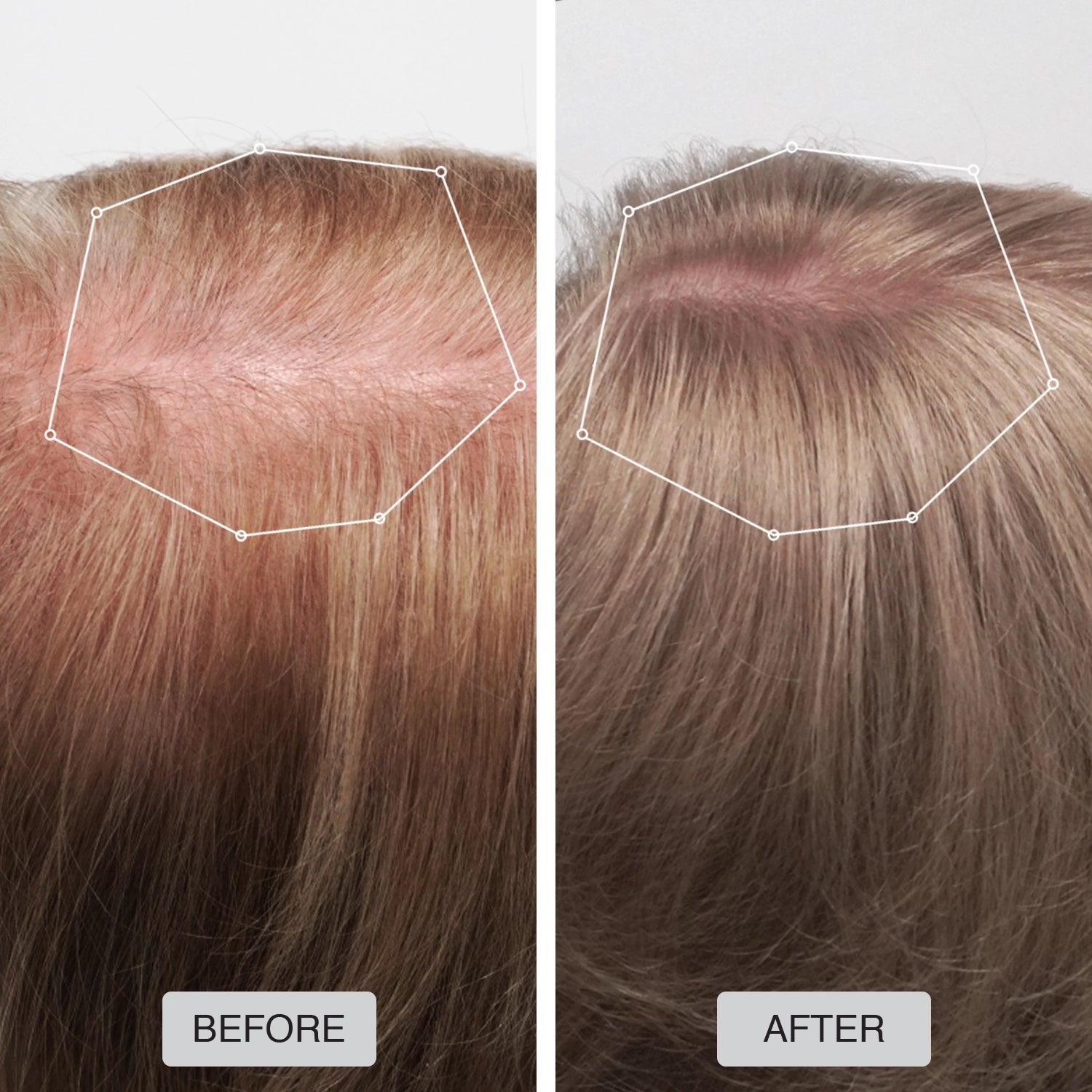 Capillus Spectrum MD