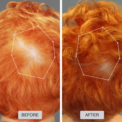 Capillus Spectrum MD