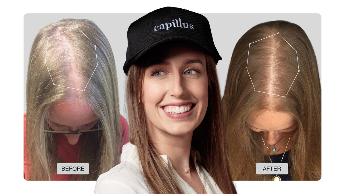 A smiling woman wearing a black Capillus hat is centered between two images of the top of her head labeled before and after, showing noticeable hair regrowth and reduced thinning in the after image.